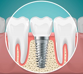 Digital image of a dental implant crown secured to the jawbone