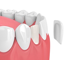 A diagram of porcelain veneers.