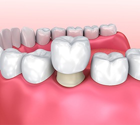 3D illustration of a dental crown capping a prepared tooth.
