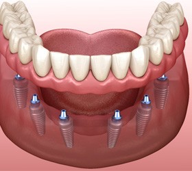 Digital illustration of implant dentures