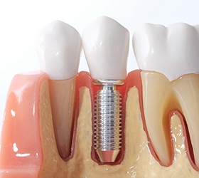 Dental implants can permanently restore your smile