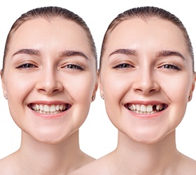 Dental implants can help patients who are missing one or more teeth