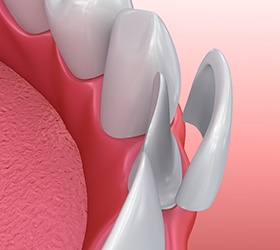 Illustration of veneer being placed on lower front tooth