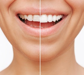 Closeup of patient's smile before and after veneers