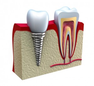 dental implant on adult.