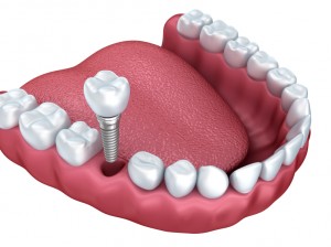 dental implants in bloomfield hills