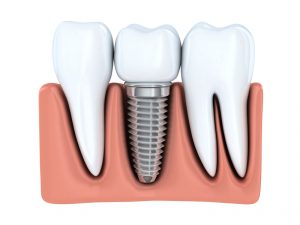 Dental Implants in Bloomfield Hills improve smile function and appearance. Read more from implant dentist, Dr. David G. Banda at Cranbrook Dental Care.