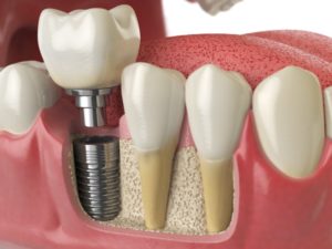 computer rendering of dental implants