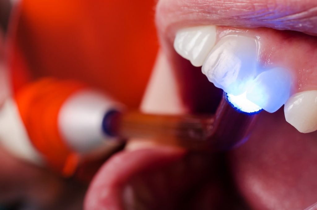 Can You Whiten Bonded Teeth? Here Are Your Options