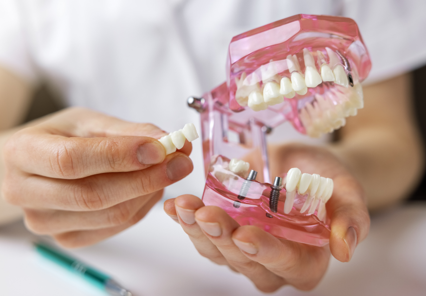 Dental implant model